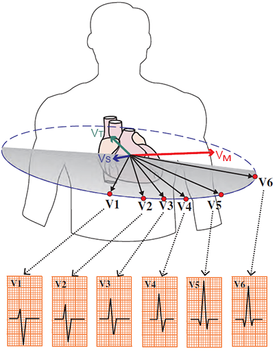 Chest leads with heart vectors, and QRS complex formation