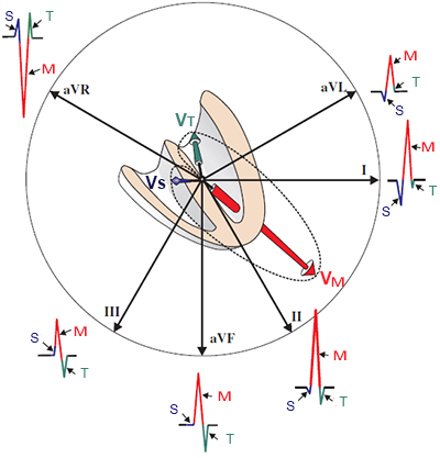 Limb leads with heart vectors, and QRS complex formation