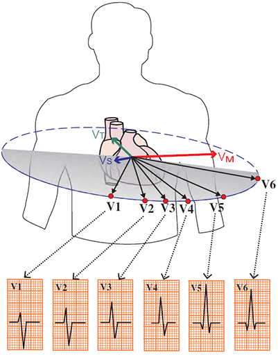 Vectorcardiogram with chest leads and QRS complex formation