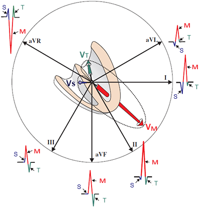 Vectorcardiogram with limb leads and QRS complex formation