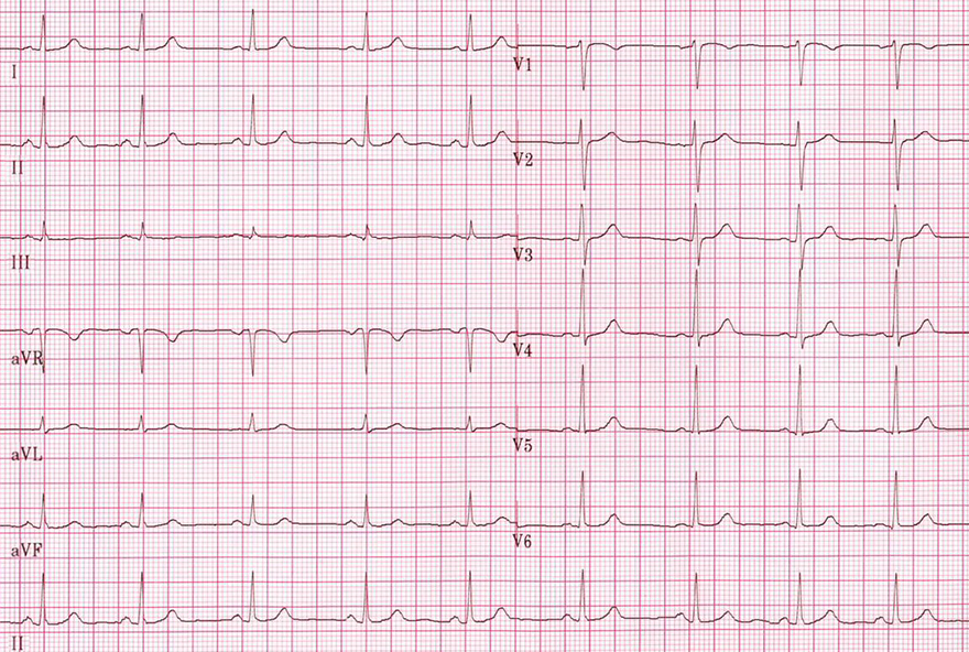 ECG sinus rhythm with P waves and QRS complexes