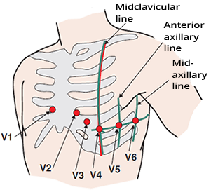 ECG chest electrodes (V1, V2, V3, V4, V5, V6) and precordial position