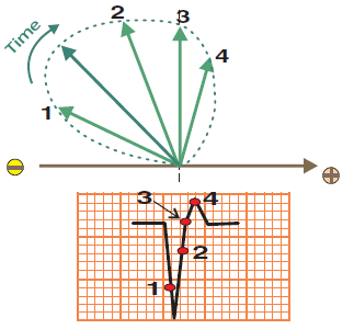 Predominantly negative ECG deflection with vector rotation