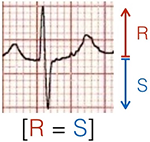 Calculating heart axis with equiphasic - biphasic QRS complex