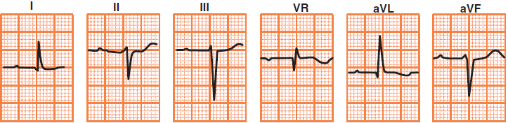 ECG deflection in left superior heart axis deviation