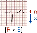 Calculating heart axis with negative QRS complex