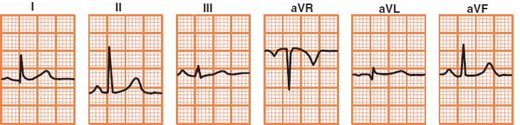 ECG deflection in normal intermediate heart axis