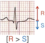 Calculating heart axis with positive QRS complex