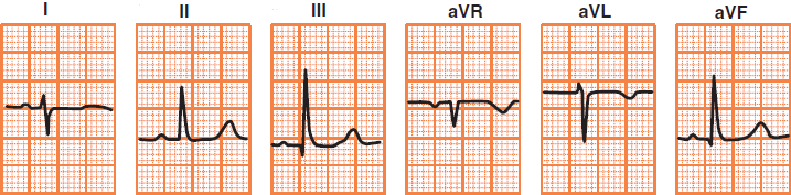 ECG deflection in right heart axis deviation