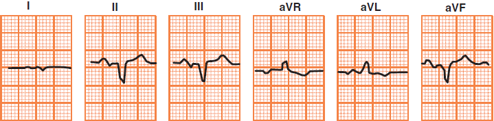 ECG deflection in extreme right superior axis deviation