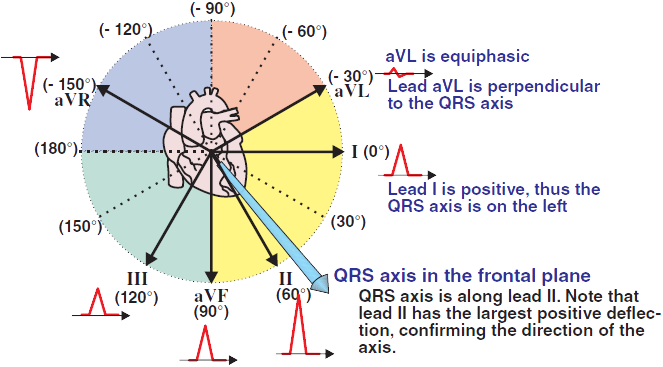 Perpendicular electrical vector and equiphasic QRS complex in determination of heart axis