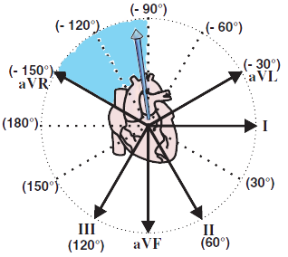 Electrical vector and extreme right superior axis deviation