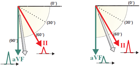 Heart electrical vector in appropriate quadrant, tallest R wave or deepest S wave