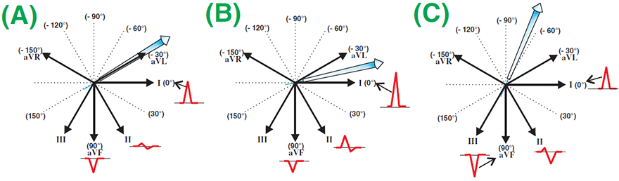 Determination of normal and abnormal heart axis with quadrant method plus lead II