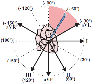 Electrical vector and left superior heart axis deviation