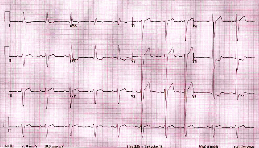 ECG left axis deviation and left ventricular hypertrophy