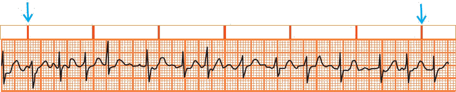 6 seconds method for determining the heart rate during irregular rhythm