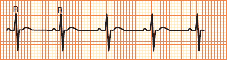 ECG sinus tachycardia, calculation heart rate 100 bpm