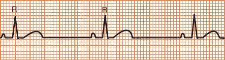 ECG sinus bradycardia, calculation heart rate 50 bpm