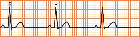 ECG sinus rhythm, calculation heart rate 60 bpm