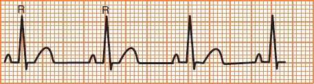 ECG sinus rhythm, calculation heart rate 75 bpm