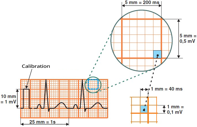 ECG small square, large square, paper speed 25mmm pre second