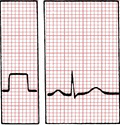 ECG calibration 1mV = 5mm