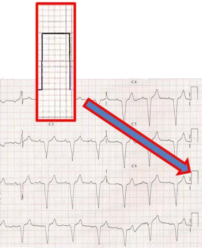 Calibration width 5mm and ECG paper speed 25mm/s