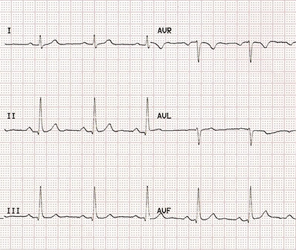 ECG paper with correct LA LL (left arm, left leg) limb electrodes