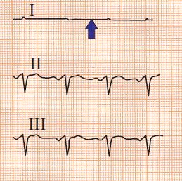 ECG pseudo-asystole in lead I, RA/RL (right arm, right leg) and LA/LL (left arm, left leg) reversal electrodes