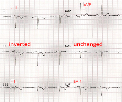 ECG paper with reversal RA LL (right arm, left leg) limb electrodes