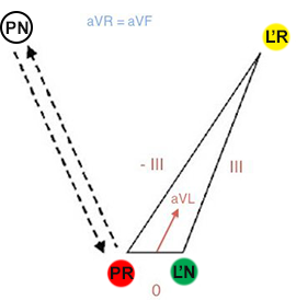 Reversal RA and RL (right arm, right leg) limb electrodes position and collapses Einthoven triangle