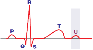 ECG U wave is associated with metabolic disturbances - hypokalemia