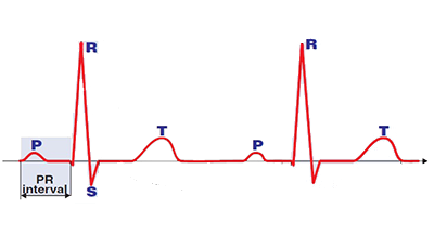 PR (PQ) interval begins at the onset of the P wave and ends at the QRS complex