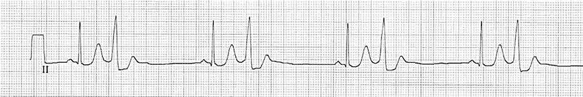 ECG narrow qrs complex (supraventricular origin), and broad qrs complex (ventricular origin)