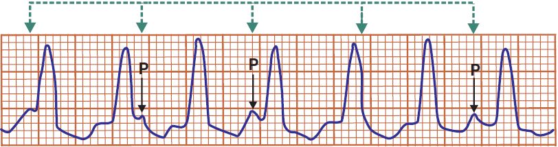 ECG broad qrs complex and ventricular tachycardia