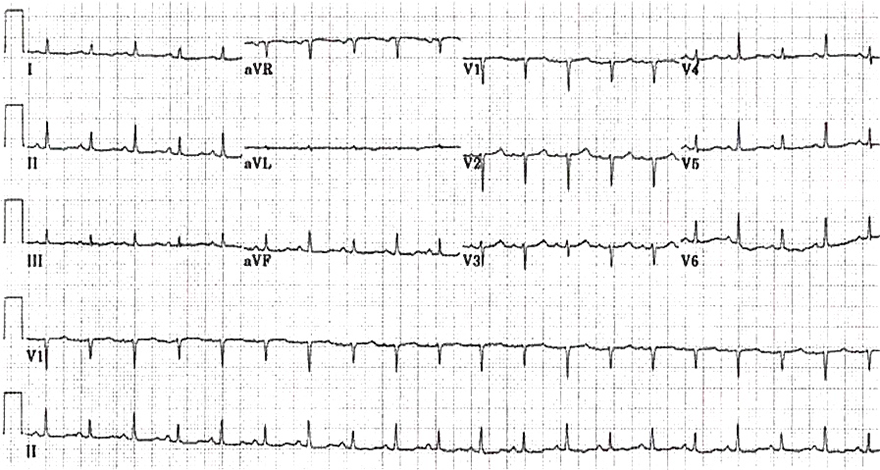 ECG QRS complexes alternate in height (voltage), massive pericardial effusion, heart swinging back and forth in pericardium