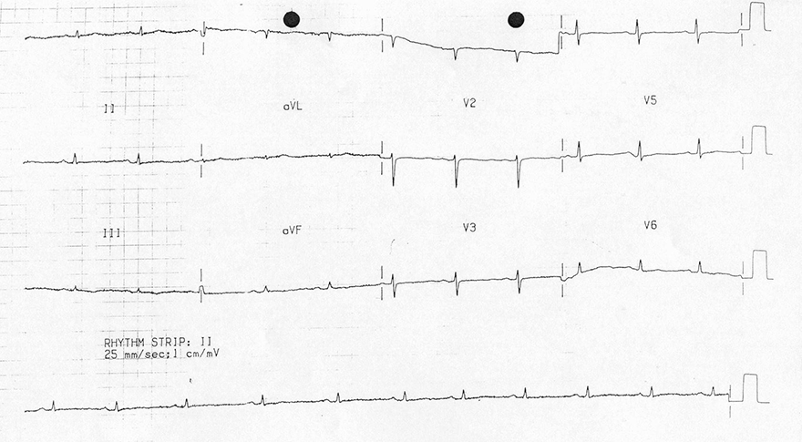 ECG low qrs voltage hypothyroidism, myxedema