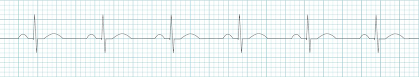 ECG narrow supraventricular qrs complex - sinus rhythm