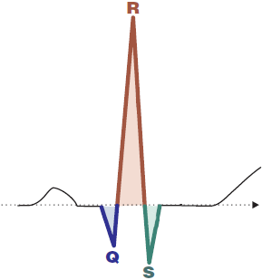 QRS complex morphology, Q wave, R wave, S wave