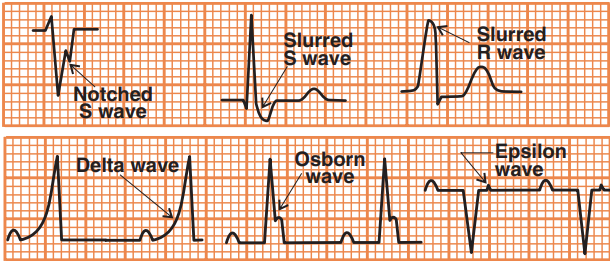 QRS complex special cases, notched, slurred, delta Osborn, epsilon wave