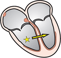 broad ventricular QRS complex