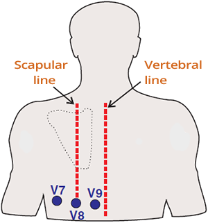 ECG posterior leads, posterior STEMI, occlusion LCx (culprit vessel). V7 (left posterior axillary line), V8 (left midscapular line), V9 (left border of the spine)