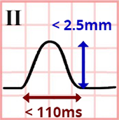 ECG lead II P wave with normal atrial size