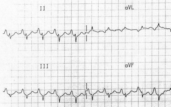 ECG P pulmonale, tall peaked P wave is sign of right atrial enlargement (hypertrophy) due to pulmonary hypertension