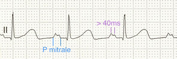 ECG p mitrale and left atrial abnormality in lead II (bifid P wave)