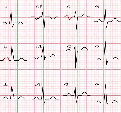 ECG p mitrale and left atrial hypertrophy in lead II (bifid P wave) and lead V1 (biphasic P wave)