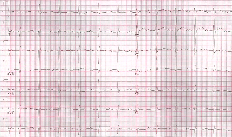 12 lead ECG and P mitrale 