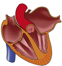 P Mitrale (Left Atrial Enlargement) - ECG book