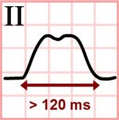 ECG P Mitrale wide 120ms